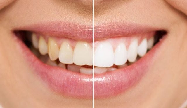 Какое отбеливание зубов лучше и безопаснее?
