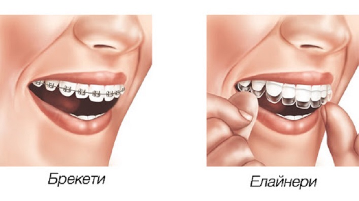 Брекети чи Елайнери - що рекомендують ортодонтологи